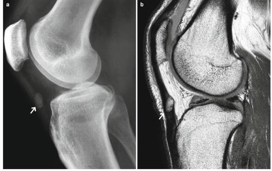 髕腱炎成為醫(yī)學(xué)焦點，從幕后走向舞臺中央的最新進展