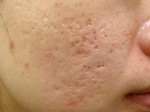 最新痘坑撫平神器，科技重塑肌膚之美，自信生活從此開始