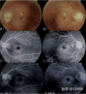 最新藥肺炎詳解，你需要知道的一切——健康小紅書